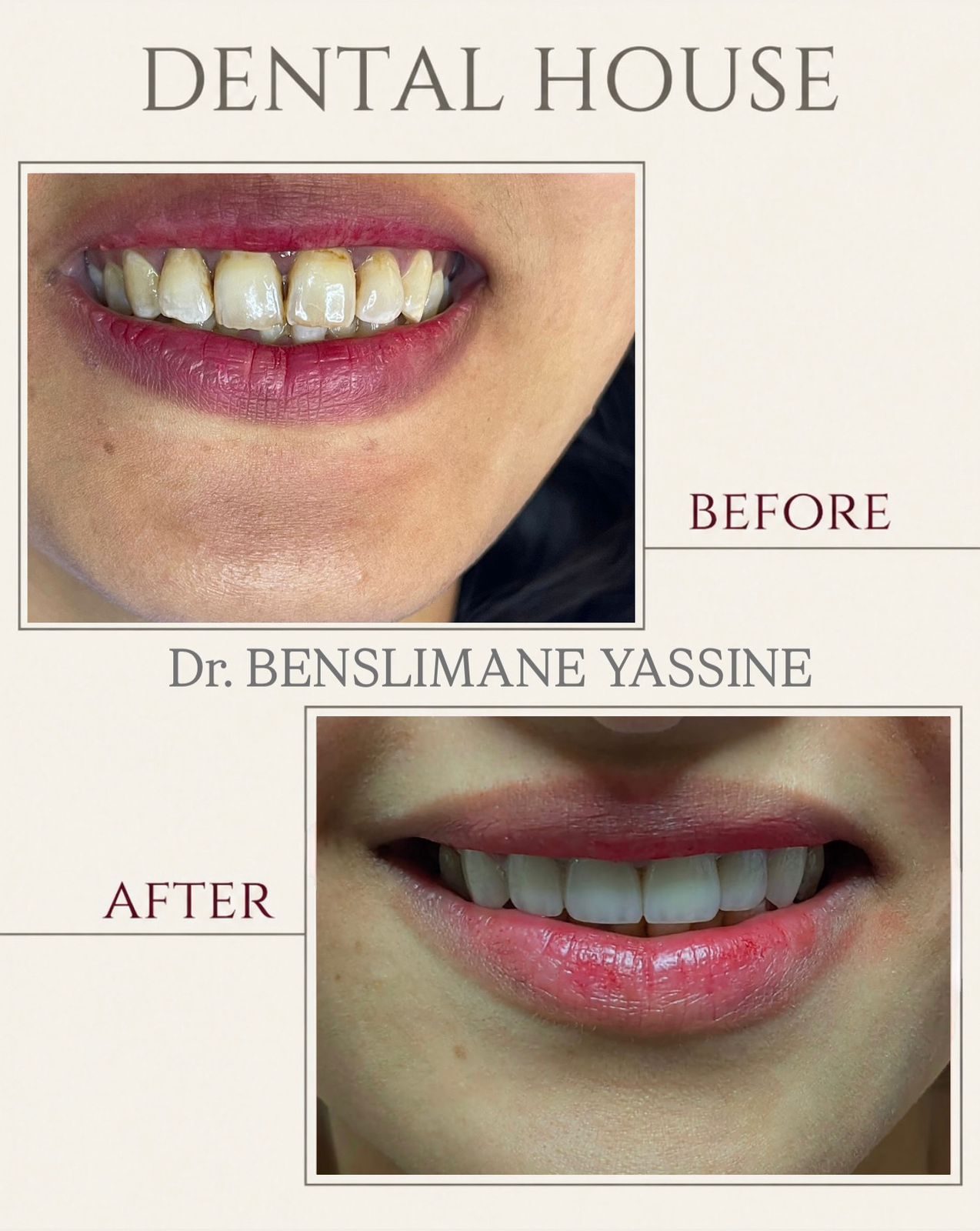 Avant / Après - esthétique du sourire - Dental House Fès